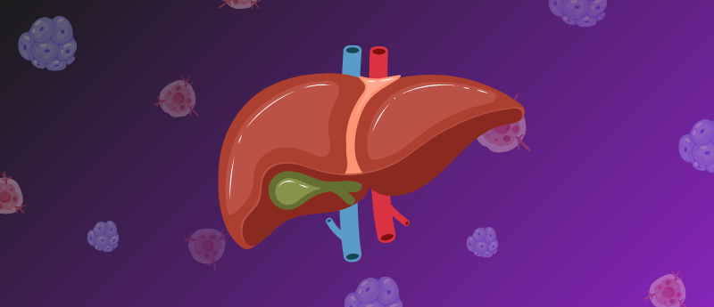 ablative therapy linked to improved survival in patients with “supermassive” bile duct tumors